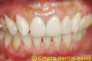 審美歯科の治療例