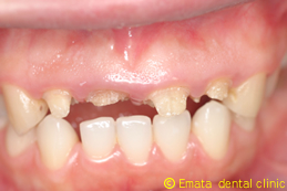 歯周外科　ジルコニアオールセラミッククラウン