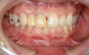 矯正治療+歯周形成外科+ホワイトニング+ジルコニアブリッジ