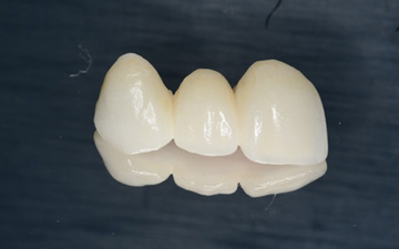 矯正治療+歯周形成外科+ホワイトニング+ジルコニアブリッジ