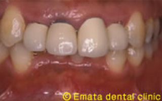 審美歯科の治療例