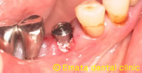 抜歯即時無切開インプラントの治療例1