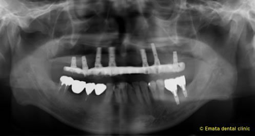 歯がまったくなくても１日で噛めるようになるインプラント治療2
