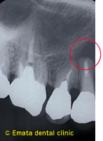 抜歯即時無切開インプラントの治療例2