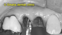 抜歯即時無切開インプラントの治療例2