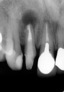 外科的歯内療法例