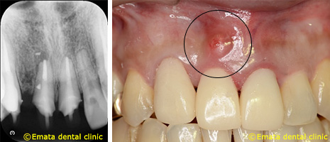外科的歯内療法例