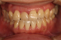 侵襲性歯周炎について