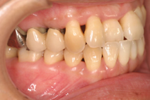 侵襲性歯周炎について