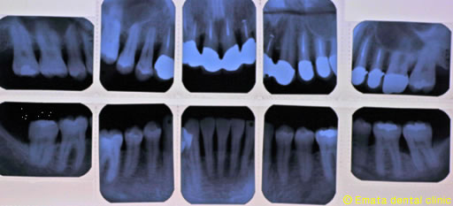 重度の歯周炎になるとフレアーアウトになります
