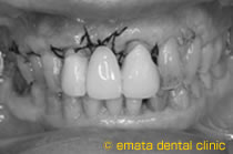 重度の歯周炎の治療2