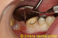 歯周病の治療例