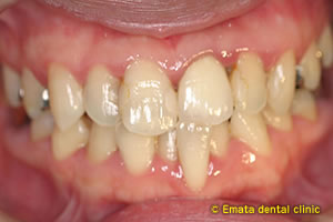 中程度の歯周病の治療例3