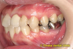 中程度の歯周病の治療例3