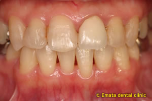 中程度の歯周病の治療例2