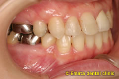 中程度の歯周病の治療例2