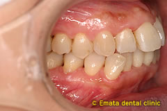 中程度の歯周病の治療例4