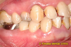 中程度の歯周病の治療例5