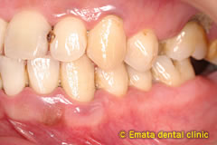 中程度の歯周病の治療例5