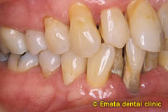中程度の歯周病の治療例1