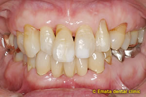 中程度の歯周病の治療例1