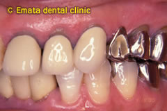 重度の歯周炎の治療1