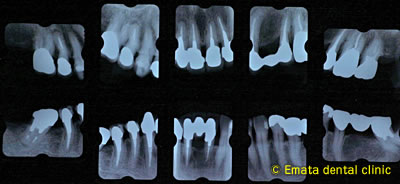 重度の歯周炎の治療1