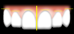歯と歯肉の高さと対称性
