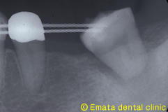 歯牙移植手術レントゲン写真