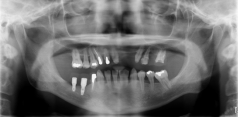 抜歯、インプラント、再生療法