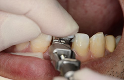 特別な専門の装置で折れた歯冠を本来の正確な位置にもどします
