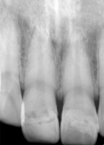 治療後のＸ線写真。歯の神経は生きてます。