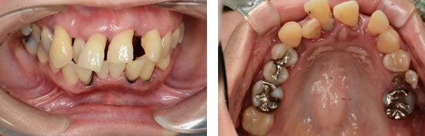 新版 現代の臨床補綴 歯周治療をふまえた補綴 インプラント治療 
