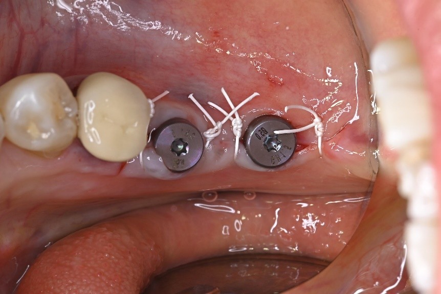 宇都宮市のインプラント専門医江俣歯科医院の3月ブログ記事9
